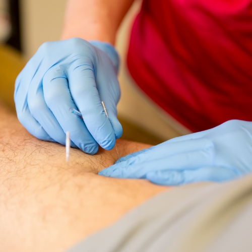 Male patient receiving dry needling treatment from a physical therapist.